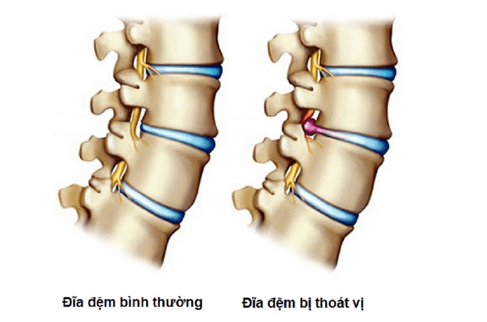 Giải nén cột sống! Lời giải cho điều trị bệnh lý đĩa đệm không xâm lấn Giai nen cot song 04 - Giải nén cột sống! Lời giải cho điều trị bệnh lý đĩa đệm không xâm lấn