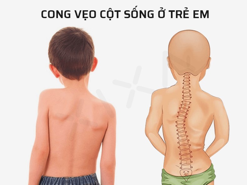 cong veo cot song o tre - Phục hồi chức năng vẹo cột sống: Giải ph&aacute;p trị liệu hiệu quả, an to&agrave;n v&agrave; tối ưu