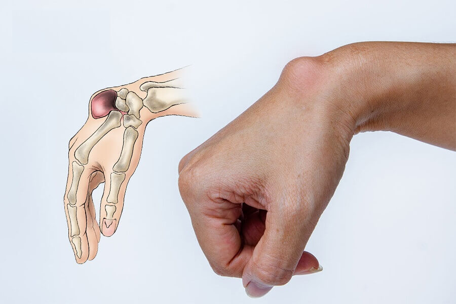 dieu tri viem bao hoat dich co tay - Điều trị vi&ecirc;m bao hoạt dịch cổ tay