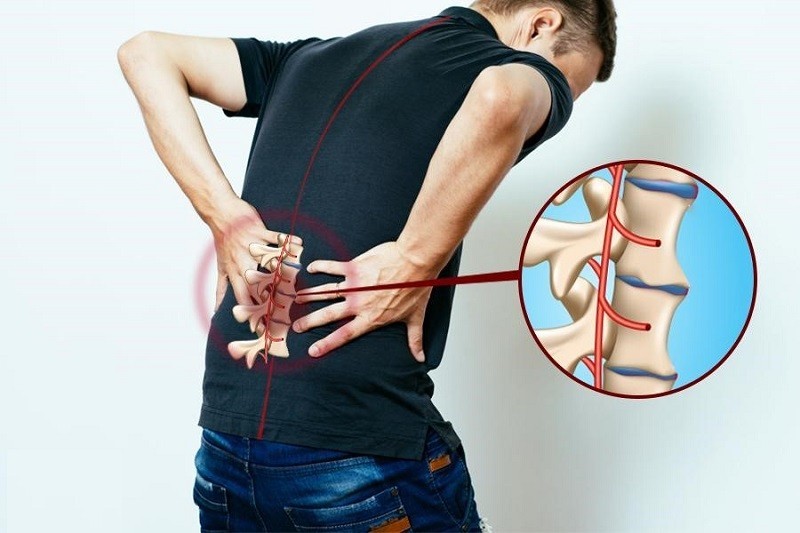 viem da re than kinh - Vi&ecirc;m đa rễ thần kinh: nguy&ecirc;n nh&acirc;n, triệu chứng v&agrave; c&aacute;c phương ph&aacute;p phục hồi chức năng