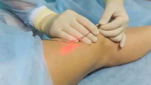 Ứng dụng và kỹ thuật điều trị laser nội mạch công suất thấp