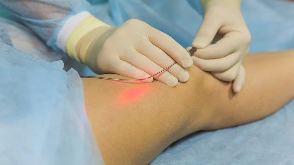 ung dung va ky thuat dieu tri laser noi mach cong suat thap - Ứng dụng và kỹ thuật điều trị laser nội mạch công suất thấp