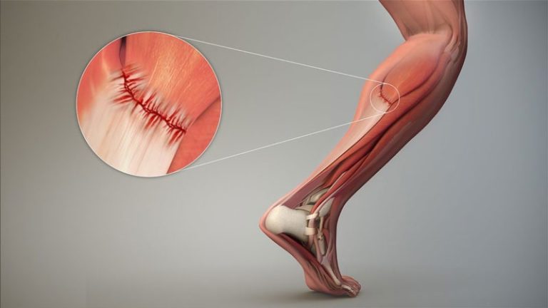 Tổng hợp các phương pháp điều trị rách cơ phổ biến - Thiết bị y tế Hải Minh