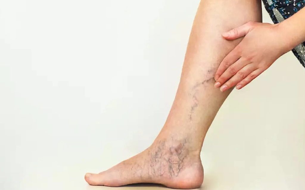 gian tinh mach 1024x638 - Ứng dụng điều trị suy gi&atilde;n tĩnh mạch bằng laser nội mạch