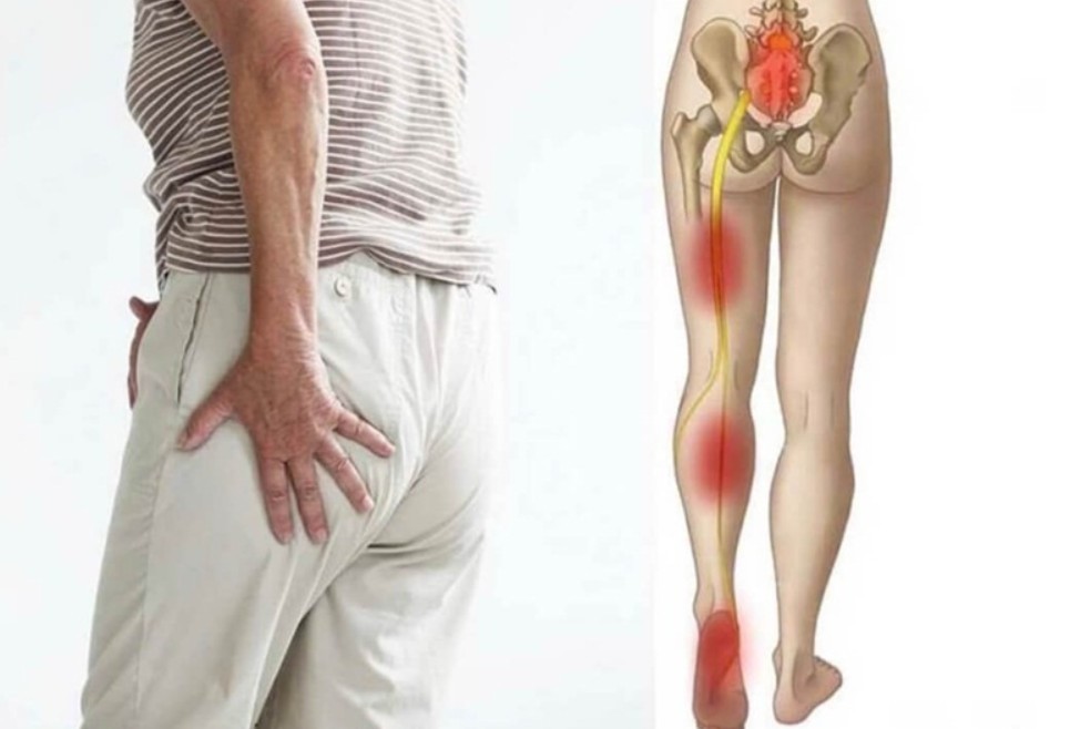 dau than kinh toa - Phục hồi chức năng do đau thần kinh