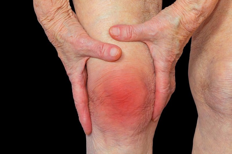 trieu chung viem khop dang thap - Phục hồi chức năng vi&ecirc;m khớp dạng thấp