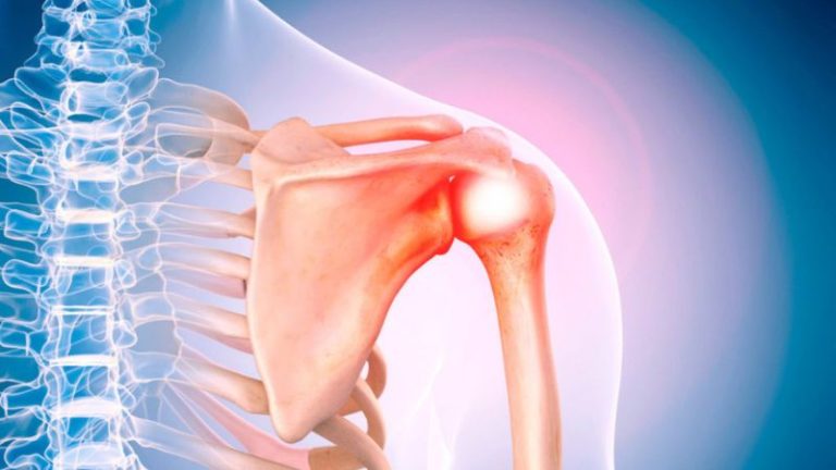 Rách chóp xoay là gì? Phục hồi chức năng sau phẫu thuật rách chóp xoay ...