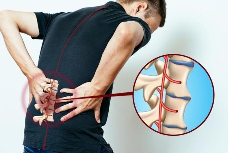 viem cot song dinh khop - C&aacute;ch điều trị vi&ecirc;m cột sống d&iacute;nh khớp