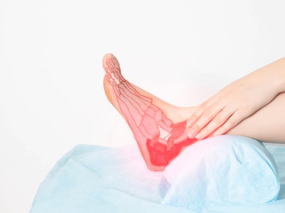 dieu tri viem gan got chan achilles - Điều Trị Vi&ecirc;m G&acirc;n G&oacute;t Ch&acirc;n Achilles: Ph&aacute;c Đồ Điều Trị, B&agrave;i Tập Chuẩn